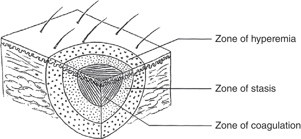 A diagram of skin layers showing zones of hyperemia, stasis, and coagulation. A cuboidal cross-sectional diagram of skin displays three distinct concentric zones with center point at one vertex. The outermost layer is labeled as the zone of hyperemia and is represented with a dotted texture. The middle layer is labeled as the zone of stasis and is illustrated with denser dots. The innermost layer is labeled as the zone of coagulation and is shown with tightly packed lines forming a triangular shape at the center. Hair follicles are visible on the surface and extend downward into the outermost zone. The innermost layer of the cuboid displays the tissue.