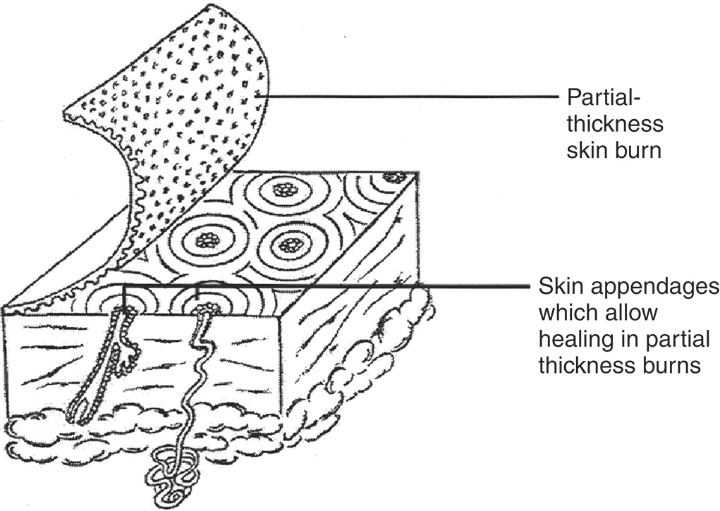 A cuboidal diagram showing a partial thickness skin burn and skin appendages. The diagram illustrates a cuboidal cross-sectional view of skin. The top layer of the skin is shown lifting or peeling away and is labeled as partial thickness skin burn. Beneath this layer, the dermis contains visible structures, including hair follicles and sweat glands. These structures are labeled as skin appendages. It highlights concentric layers on the surface below the skin burn and different layers and components below that layer.