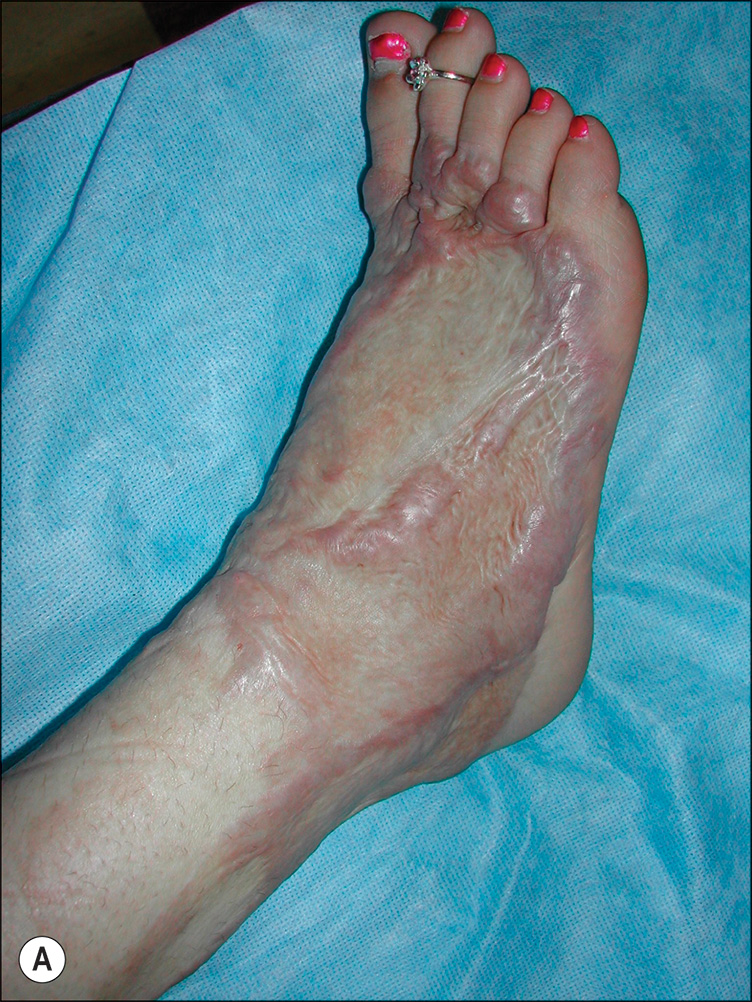 Three photographs show a foot with visible scarring and skin changes. Three photographs labeled A, B, and C show different views of a right foot and lower leg. Photo A presents a top-down view of the right foot resting on a cloth. The skin shows visible scarring concentrated around the ankle and extending toward the toes, with areas of redness but not on the tips of toes. Photo B is a closer top-down view of the same foot, focusing on the toes and upper foot. The big toe has pale discoloration at the tip, and the other toes show swelling and scarring. Photo C shows a side view of the lower leg and foot resting on a cloth. Extensive scarring is visible from on the lower leg down to the ankle, with consistent redness along the affected area and paleness on the toes.