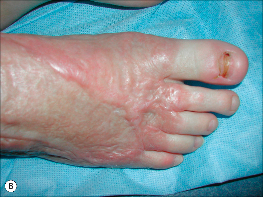 Three photographs show a foot with visible scarring and skin changes. Three photographs labeled A, B, and C show different views of a right foot and lower leg. Photo A presents a top-down view of the right foot resting on a cloth. The skin shows visible scarring concentrated around the ankle and extending toward the toes, with areas of redness but not on the tips of toes. Photo B is a closer top-down view of the same foot, focusing on the toes and upper foot. The big toe has pale discoloration at the tip, and the other toes show swelling and scarring. Photo C shows a side view of the lower leg and foot resting on a cloth. Extensive scarring is visible from on the lower leg down to the ankle, with consistent redness along the affected area and paleness on the toes.