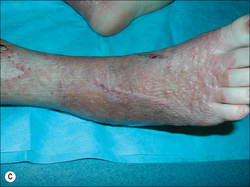 Three photographs show a foot with visible scarring and skin changes. Three photographs labeled A, B, and C show different views of a right foot and lower leg. Photo A presents a top-down view of the right foot resting on a cloth. The skin shows visible scarring concentrated around the ankle and extending toward the toes, with areas of redness but not on the tips of toes. Photo B is a closer top-down view of the same foot, focusing on the toes and upper foot. The big toe has pale discoloration at the tip, and the other toes show swelling and scarring. Photo C shows a side view of the lower leg and foot resting on a cloth. Extensive scarring is visible from on the lower leg down to the ankle, with consistent redness along the affected area and paleness on the toes.