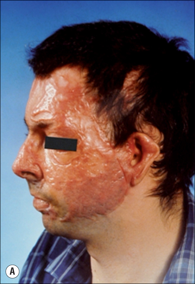 Four photographs, labeled A to D, of a person with elevated scars due to burns. Photo A shows a side view focusing on the face with heavy scarring and redness, where there is a distinct elevation of scars. The skin is saggy with wrinkle lines. Photo B is a side view of a hand placed on a surface with scars that appear elevated and inflamed. Photo C is a top view of two palms and wrist placed on a surface with elevated spots affected by burn and redness. Photo D is a front view of the left part of torso with scars originating in the humerus and radiating outward. They resemble tree bramches and appear to be over the skin surface.