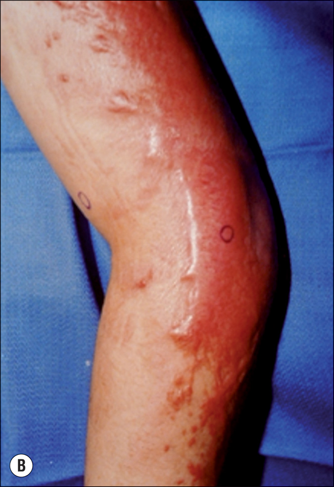 Four photographs, labeled A to D, of a person with elevated scars due to burns. Photo A shows a side view focusing on the face with heavy scarring and redness, where there is a distinct elevation of scars. The skin is saggy with wrinkle lines. Photo B is a side view of a hand placed on a surface with scars that appear elevated and inflamed. Photo C is a top view of two palms and wrist placed on a surface with elevated spots affected by burn and redness. Photo D is a front view of the left part of torso with scars originating in the humerus and radiating outward. They resemble tree bramches and appear to be over the skin surface.