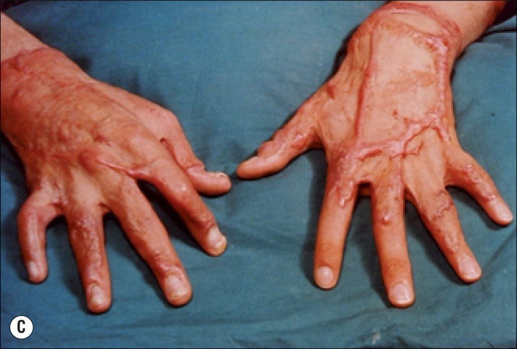 Four photographs, labeled A to D, of a person with elevated scars due to burns. Photo A shows a side view focusing on the face with heavy scarring and redness, where there is a distinct elevation of scars. The skin is saggy with wrinkle lines. Photo B is a side view of a hand placed on a surface with scars that appear elevated and inflamed. Photo C is a top view of two palms and wrist placed on a surface with elevated spots affected by burn and redness. Photo D is a front view of the left part of torso with scars originating in the humerus and radiating outward. They resemble tree bramches and appear to be over the skin surface.