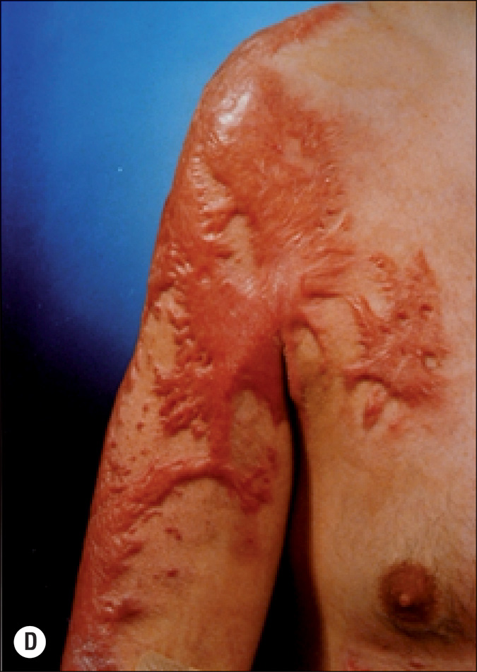 Four photographs, labeled A to D, of a person with elevated scars due to burns. Photo A shows a side view focusing on the face with heavy scarring and redness, where there is a distinct elevation of scars. The skin is saggy with wrinkle lines. Photo B is a side view of a hand placed on a surface with scars that appear elevated and inflamed. Photo C is a top view of two palms and wrist placed on a surface with elevated spots affected by burn and redness. Photo D is a front view of the left part of torso with scars originating in the humerus and radiating outward. They resemble tree bramches and appear to be over the skin surface.