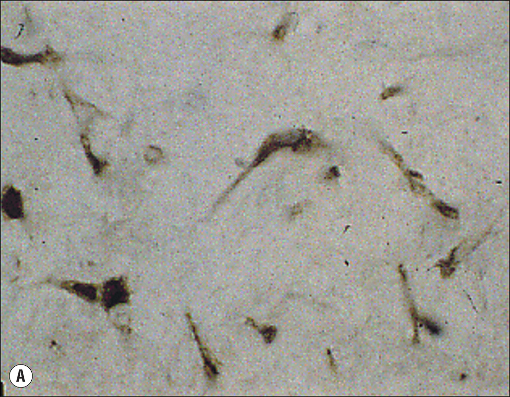 Six microscopic images, labeled A to F, show cellular structures related to hypertrophic scar formation. Six panels labeled A through F, each showing microscopic views of cells. Panel A shows scattered elongated cells. Panel B displays a few elongated cells with more defined outlines. Panel C presents a close-up of an elongated cell with visible extensions. Panel D shows clusters of small rounded cells. Panel E depicts scattered dark cells with arrows pointing to specific features. Panel F shows two adjacent cells with clearly visible nuclei.