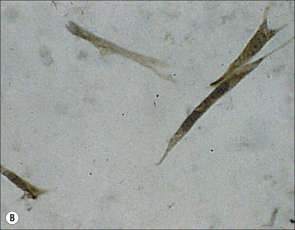Six microscopic images, labeled A to F, show cellular structures related to hypertrophic scar formation. Six panels labeled A through F, each showing microscopic views of cells. Panel A shows scattered elongated cells. Panel B displays a few elongated cells with more defined outlines. Panel C presents a close-up of an elongated cell with visible extensions. Panel D shows clusters of small rounded cells. Panel E depicts scattered dark cells with arrows pointing to specific features. Panel F shows two adjacent cells with clearly visible nuclei.