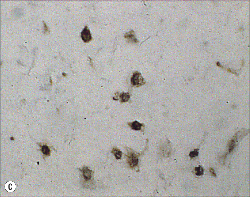 Six microscopic images, labeled A to F, show cellular structures related to hypertrophic scar formation. Six panels labeled A through F, each showing microscopic views of cells. Panel A shows scattered elongated cells. Panel B displays a few elongated cells with more defined outlines. Panel C presents a close-up of an elongated cell with visible extensions. Panel D shows clusters of small rounded cells. Panel E depicts scattered dark cells with arrows pointing to specific features. Panel F shows two adjacent cells with clearly visible nuclei.