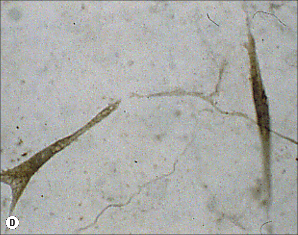 Six microscopic images, labeled A to F, show cellular structures related to hypertrophic scar formation. Six panels labeled A through F, each showing microscopic views of cells. Panel A shows scattered elongated cells. Panel B displays a few elongated cells with more defined outlines. Panel C presents a close-up of an elongated cell with visible extensions. Panel D shows clusters of small rounded cells. Panel E depicts scattered dark cells with arrows pointing to specific features. Panel F shows two adjacent cells with clearly visible nuclei.