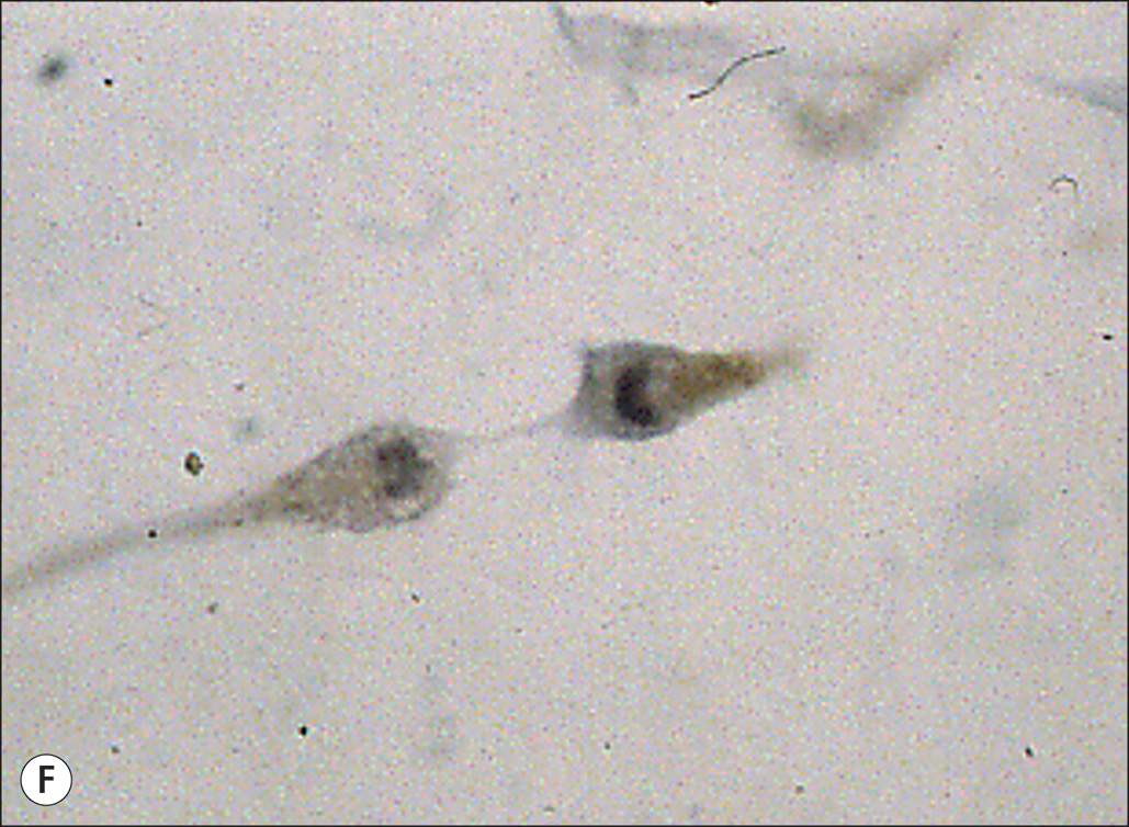 Six microscopic images, labeled A to F, show cellular structures related to hypertrophic scar formation. Six panels labeled A through F, each showing microscopic views of cells. Panel A shows scattered elongated cells. Panel B displays a few elongated cells with more defined outlines. Panel C presents a close-up of an elongated cell with visible extensions. Panel D shows clusters of small rounded cells. Panel E depicts scattered dark cells with arrows pointing to specific features. Panel F shows two adjacent cells with clearly visible nuclei.
