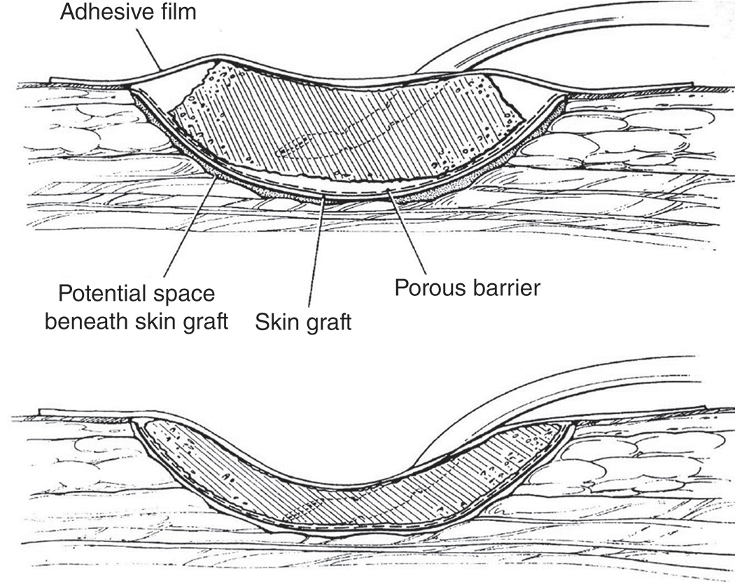 Two illustrations of a skin graft with negative pressure wound therapy dressing before and after suction activation. Two cross-sectional illustrations of a skin graft as a flat layer with a bulged portion in between labeled skin graft. The top illustration shows the dressing before suction is activated. It includes labels for adhesive film, potential space beneath the skin graft, porous barrier, and skin graft. The bottom illustration shows the same setup after suction is activated, with the potential space beneath the skin graft eliminated and the dressing contouring closely to the wound bed.
