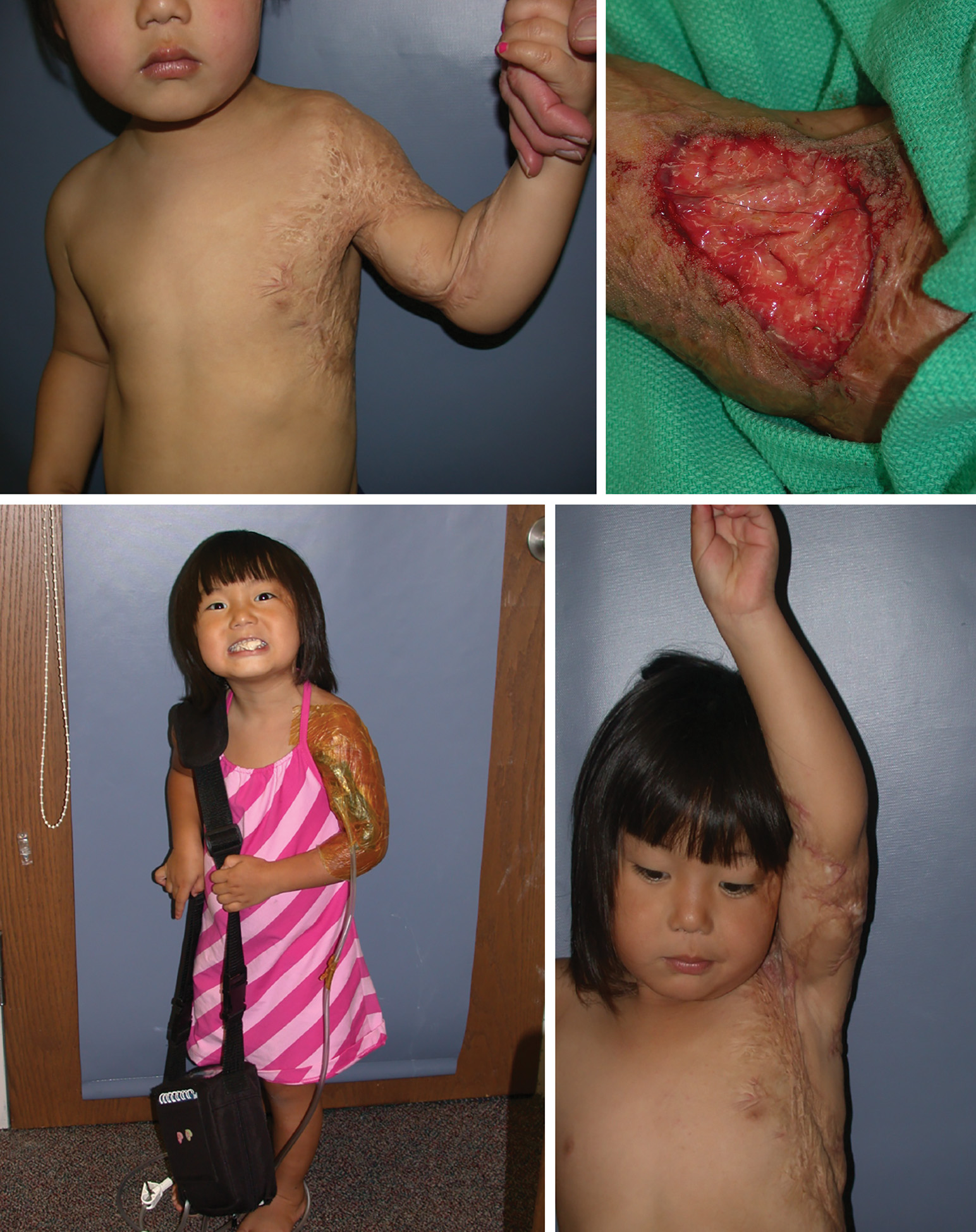 4 photos of a child affected by a burn. The first photo has a child whose left arm is suffering burn injury and is flexed at 45 degrees. The shoulder joint is most affected. The second photo is an intraoperative one, where the incised skin is focused on the humerus region. The third photo is a front view with a partially recovered arm and a hanging portable tube device. The last photo is the one with raised arms without any portable device, and the recovery is maximal.