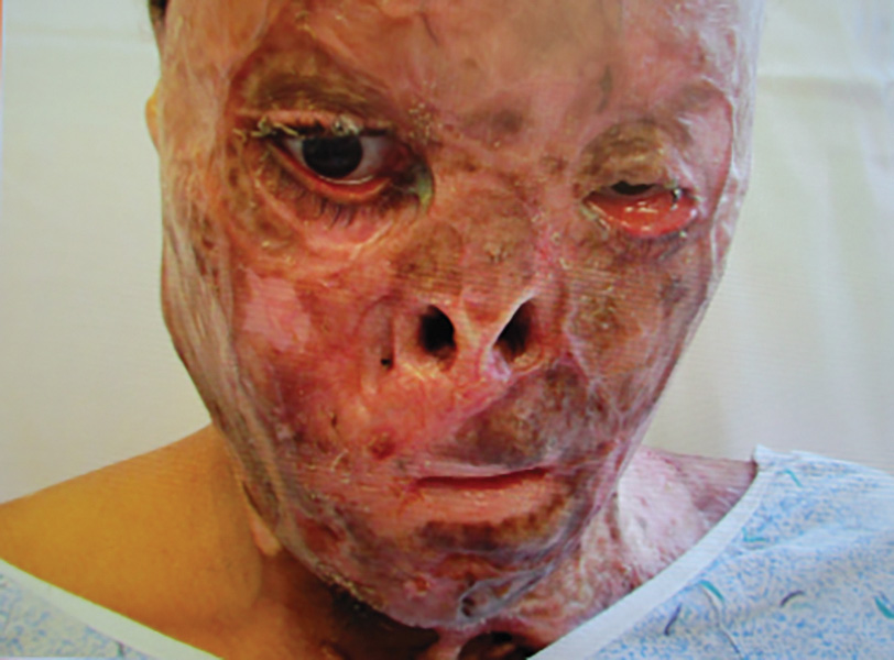 A photo of a distressed person with severe facial injuries and burns. A close-up photo of a person's face shows significant damage to the facial skin, with darkened areas and open wounds throughout as patches. The eyes are also shrunken. There is a partial open left eye and almost fully shrunken right eye. Eyelids are damaged and cheek area is fully shrunken on the right and partially bulged on the left.