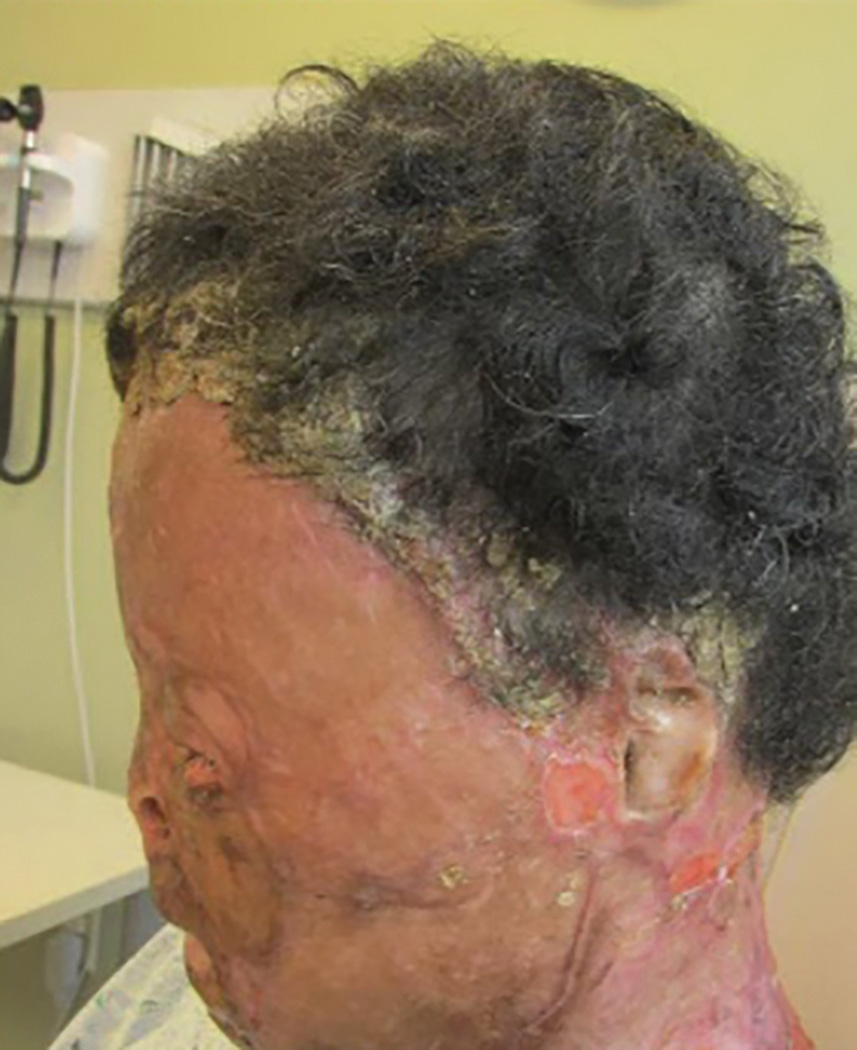 A side-view photo of a person in a hospital setting taken from the right with facial injuries and greying of front hair. The photo shows redness, swelling, and peeled skin. Eyes are fully shrunken.