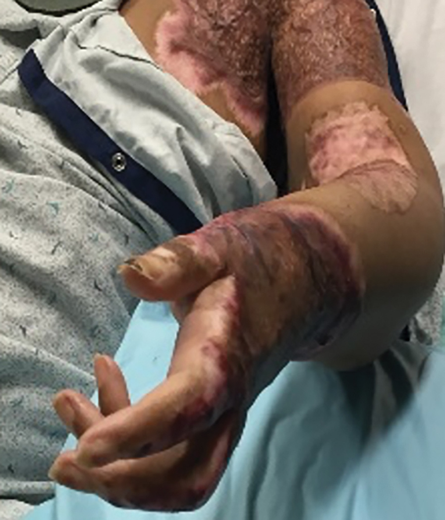 A photo of a person's torso and raised hand with heavy scars and peeled skin in large patches. The photo shows only the left hand and shoulder region uncovered next to it while the rest of the body is covered by cloth. One patch covers the shoulder and humerus part. One peeled skin is around the elbow. Another patch extends from the wrist to the digits on the palmar side.