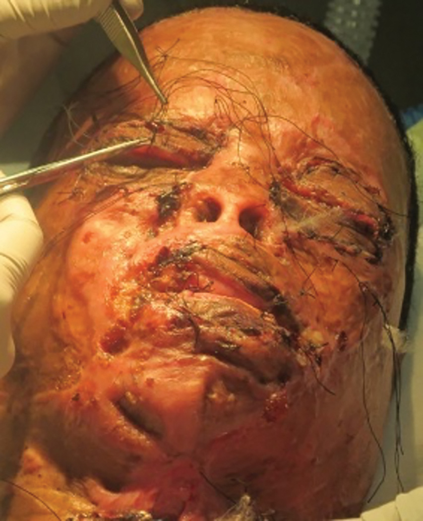 A photo of a surgical procedure being performed on the eyelids of a person with external burns. The person's eyes are closed and shrunken. The eyelids are misaligned or partially absent. The lips are raised on one side. Suture threads are laid throughout the left cheek, both eyes, and forehead. A person operates on the patient using a forceps and scissors.