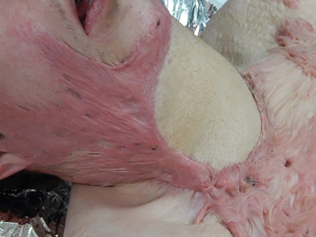 A photo of the lower face and shoulder region of a patient lying in bed. The photo has the appearance of alternating patches of redness in elevated skin flaps and plain areas of the inner layer without flaps. These inner layer areas are in the neck and shoulder while a flap extends from face to chest via the neck.