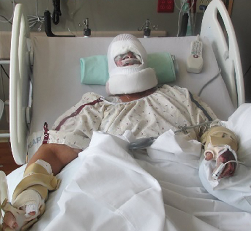 A photo of the whole body of a patient lying in a bed. The face, neck, and hands are covered with bandages while only the nostrils and mouth are open to use.