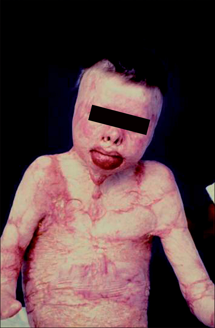 A photo of a child's face and upper body with severe burns. The photo shows swollen lips, shrunken body posture and saggy skin. The sagginess is majorly in the lower body and shoulder joints. The entire body, including the torso, arms, and head is covered by patches of redness due to linear and massive burn-affected areas. The lower lip is heavily swollen and the face has less elevated scarring compared to the chest and abdomen. The eyes are obscured by a bar for privacy.