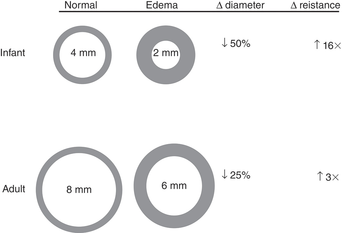 A diagram comparing the effect of 1 millimeter circumferential edema on infant (4 and 2 millimeters) and adult (8 and 6 millimeters) airways shows a much larger increase in resistance for the infant. The comparative diagram illustrates the age-dependent effects of airway edema on airway resistance, contrasting an Infant's and an Adult's airway. For an Infant, circumferential edema that reduces the 4 millimeter normal airway diameter to 2 millimeters with a 50 percent decrease results in a 16-fold increase in airway resistance. For an Adult, the same edema reduces the 8 millimeter normal airway diameter to 6 millimeters with a 25 percent decrease, resulting in only a 3-fold increase in airway resistance. This highlights the disproportionately severe impact of inhalation injury and subsequent edema on the pediatric airway.