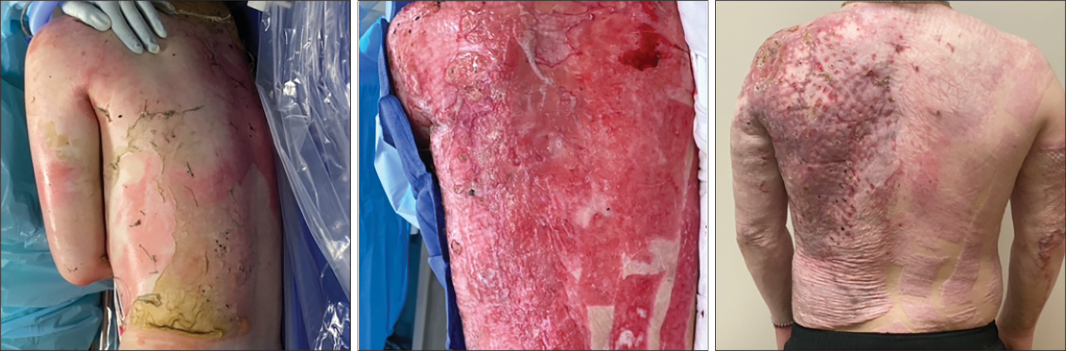 A series of three photographs labeled A, B, and C depicts the progression of an injury on a patient's back and torso that proceeds from an acute stage on the left to a healed region on the right. The series of three clinical photographs depicts the patient's torso and back, labeled A, B, and C. The left illustration labeled A presents the lateral view of the body with a large, fluid-filled area of injury, where gloved hands support the patient’s position. The middle illustration labeled B is a close-up of a large area of injury that covers the patient's torso, presenting a raw, irregular surface. The right illustration labeled C depicts the patient in a standing position, presenting the extensive, uneven skin changes with patches of lighter and darker, textured skin, with the injury covering most of the back and upper arms.