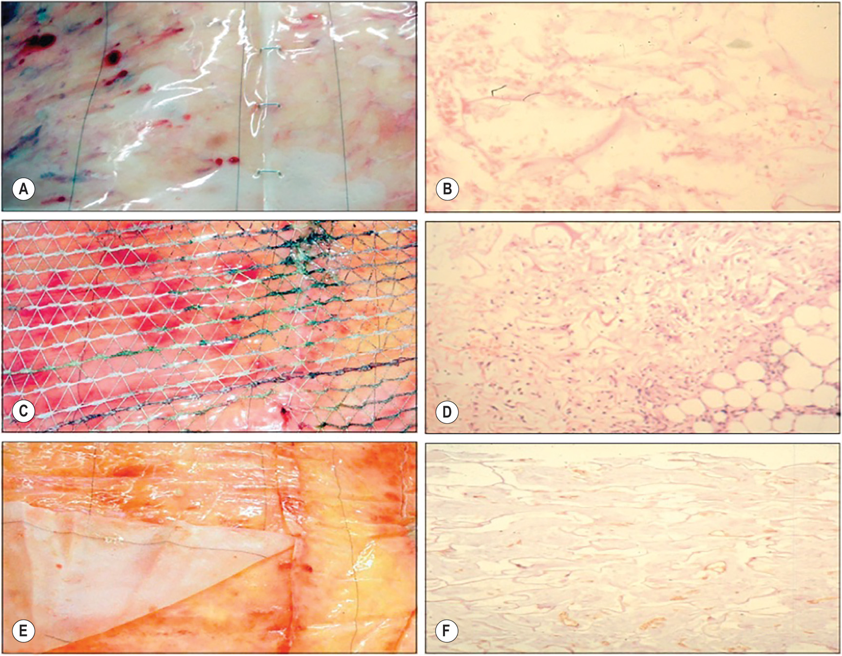 A series of six panels, labeled A through F, compares 3 real clinical photographs and 3 microscopic tissue views that illustrate how artificial skin matrix heals over time. The six panels are arranged in 2 columns and 3 rows. Panel A depicts an early surgical site with visible blood staining and two layers of tissue joined together using fine staples or sutures, suggesting immediate post-application of the graft. Panel B, linked to A, depicts a histopathology view of the same stage, where the tissue looks pale with very few visible blood vessels, representing the early phase before new circulation develops. Panel C depicts a later phase where a small, holed, triangle-patterned mesh or net structure is visible. Panel D, linked to C, depicts a microscopic view of this stage, displaying tissue growth beneath the mesh and the beginning of blood vessel formation. Panel E depicts the upper layer of skin being lifted or peeled slightly, and the staple line appears almost merged with the healing skin underneath, showing advanced recovery. Panel F, linked to E, depicts the microscopic view of this stage with dense new tissue and tiny blood vessels visible across the surface, indicating mature healing of the graft.
