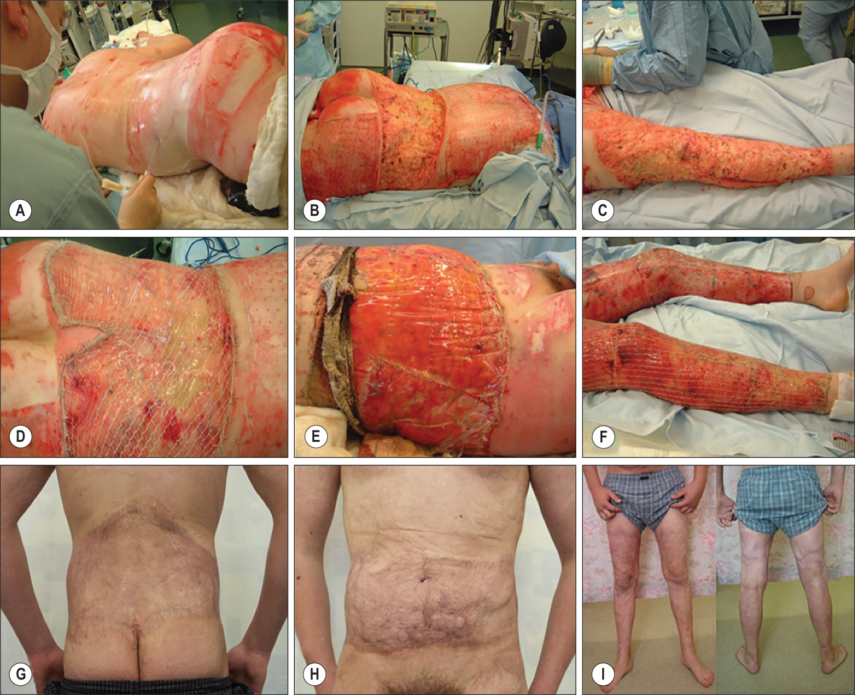 A nine-panel sequence showing burn treatment and long-term healing with Integra grafts, depicting early wounds, grafts, and fully healed areas with light scars. The nine-panel clinical image sequence labeled A to I depicts the treatment and long-term healing process of severe burn injuries on a patient’s body. Panel A depicts a patient lying face down, showing the back with visible redness, burn marks around the lower back and buttock area, and a bright, raw injury just above the buttocks. Panel B depicts a closer view of the back after surgical removal of the burned skin, revealing a large area of exposed, deep burn tissue in severe condition. Panel C depicts the leg with rough tissue and uneven wound edges where the damaged skin has been excised. Panel D depicts the back region toward the buttocks after application of the Integra sheet, appearing shiny and patchy, indicating early-stage healing and graft adherence. Panel E depicts a close-up of the abdomen with Integra attached and pinkish healing areas around the treated zone. Panel F depicts both legs with net-shaped Integra grafts attached, illustrating graft placement on the lower limbs. Panel G depicts the patient’s back, fully healed with light scars and a smoother skin texture. Panel H depicts the anterior abdomen region, healed with faint scarring and a more even skin tone. Panel I depicts the lower limbs with mature, light scars and no visible open wounds, reflecting long-term recovery after burn injury.