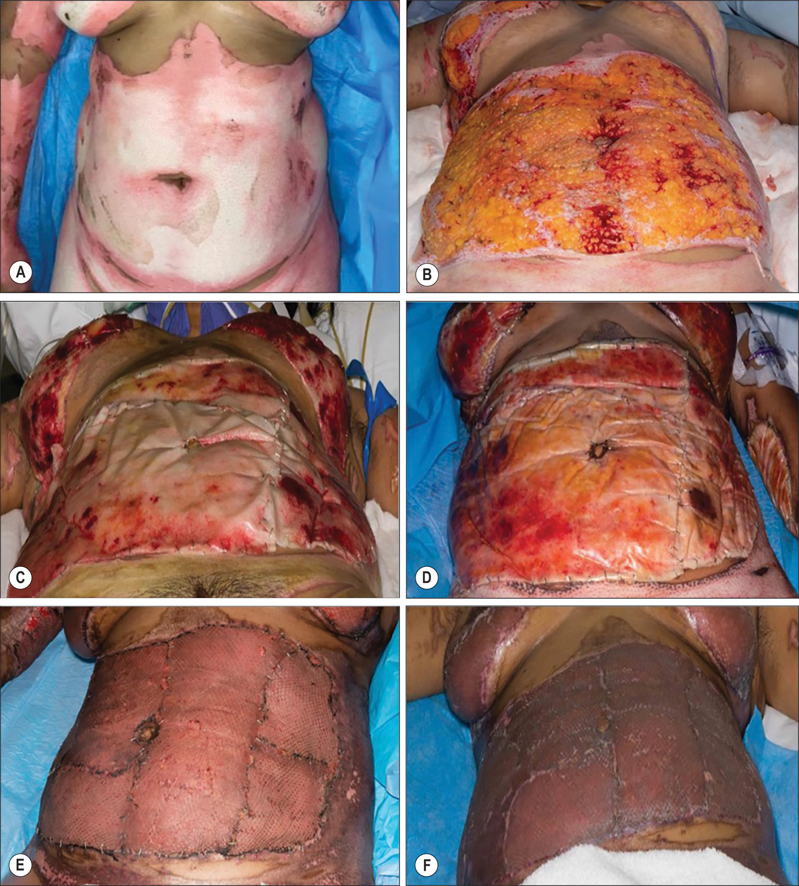 A six-panel clinical sequence showing burn treatment of the anterior abdominal region in a patient's body surface area flame burns. The panel A depicts the abdomen before surgery with deep red burn marks and raw, damaged skin. Panel B depicts the area after surgical removal of burned skin, revealing an open and tender wound. Panel C depicts the biodegradable temporizing matrix applied over the abdominal and breast wound area to protect it and support early healing. Panel D depicts the B T M-covered area with skin peeling and slightly shiny skin, indicating initial healing. Panel E depicts the second-stage procedure with a split-thickness skin graft applied to replace lost skin. Panel F, post-graft, depicts the new skin attaching well, with light, smooth scars, some peeling of the top layer, and faint burn marks, reflecting ongoing recovery and improving skin tone on the abdominal and breast area.