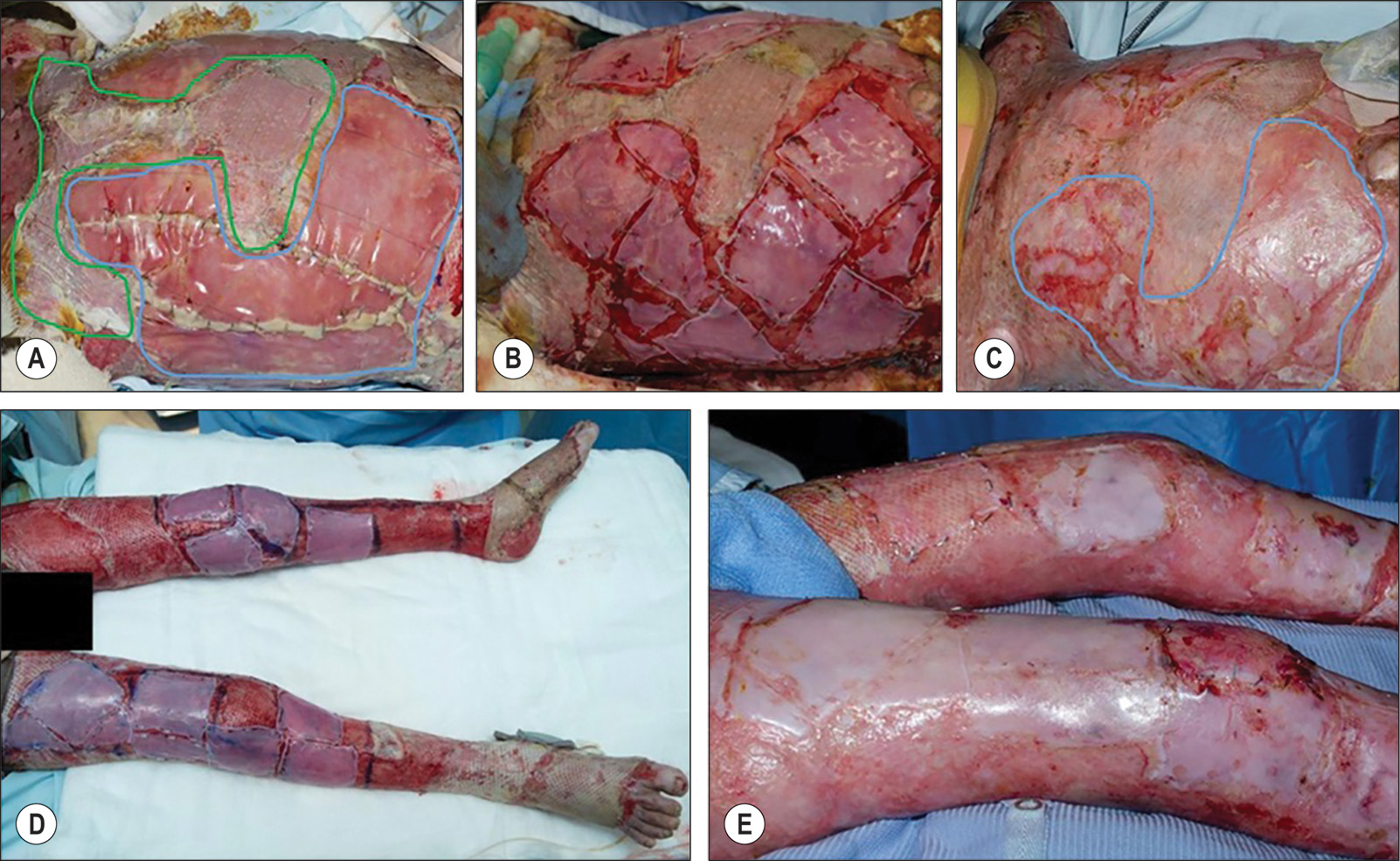 A five-panel clinical sequence showing burn wound treatment in a child's thigh and leg regions. The panel A depicts the trunk with two types of grafts in irregular shapes applied over the burned areas. Panel B depicts square-shaped patches applied to the previously treated Integra area. Panel C depicts the patches nearly merged with the surrounding skin, with faint scars, slight redness, and small remaining patches visible. Panel D depicts both legs, including thighs, knees, and feet, with square-shaped patches applied over the burn wounds. Panel E depicts a close-up of the thigh region where the patches have merged with the skin tone, leaving a bright area with light scars, indicating ongoing healing and integration of the grafted skin.