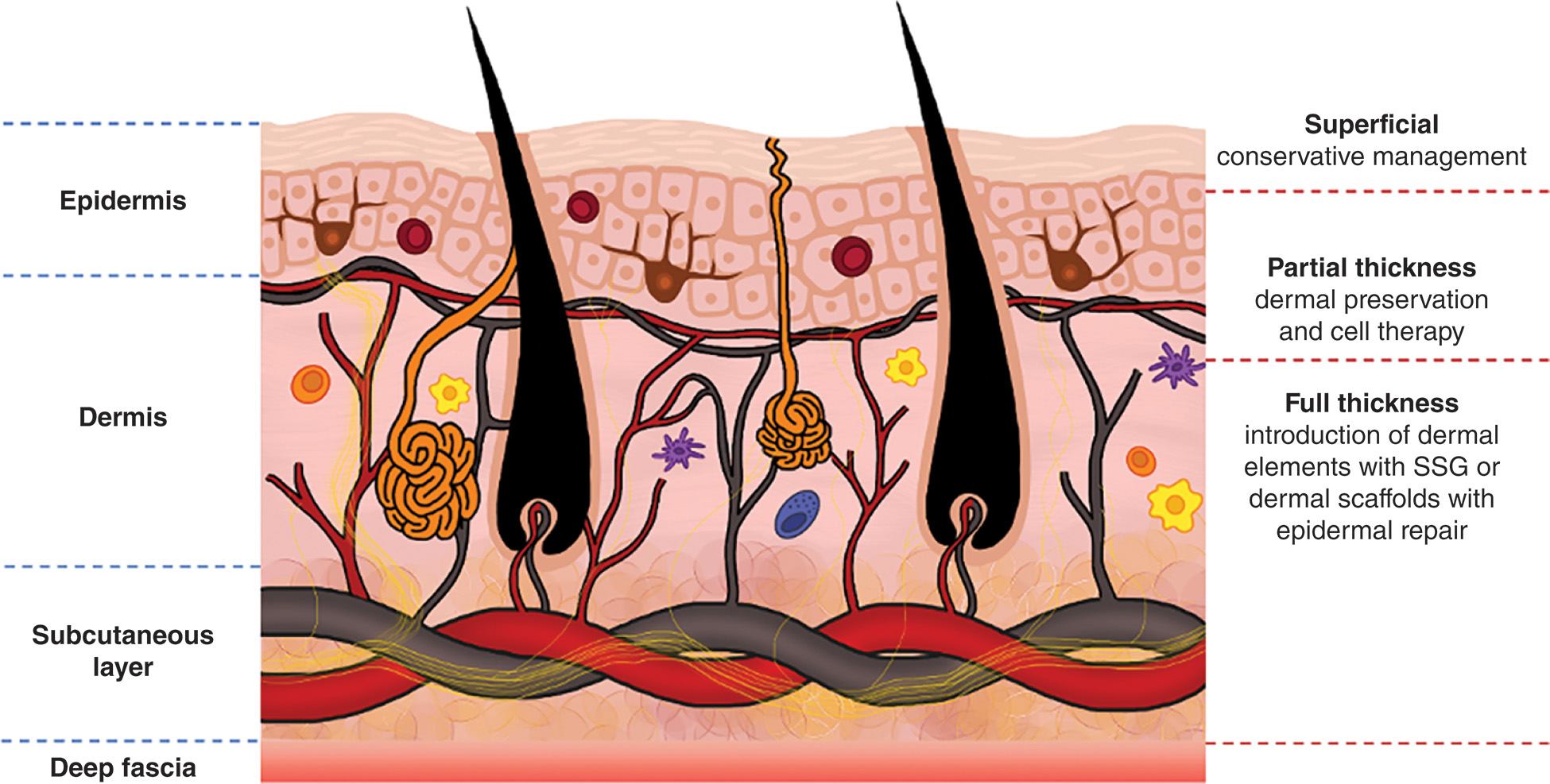 A diagram of skin layers labeled with epidermis, dermis, subcutaneous layer, and deep fascia showing superficial partial thickness and full thickness wound depths. The diagram depicts the cross-sectional anatomy of skin tissue with labeled layers including the epidermis as the outermost layer, the dermis containing hair follicles, glands, and blood vessels beneath the epidermis, the subcutaneous layer composed of adipose tissue, and the deep fascia at the bottom, with two horizontal dashed lines indicating superficial partial thickness wound depth extending into the upper dermis and full thickness wound depth extending through the entire dermis into the subcutaneous tissue, demonstrating the different depths of tissue injury that determine appropriate treatment approaches for wound healing and skin regeneration.