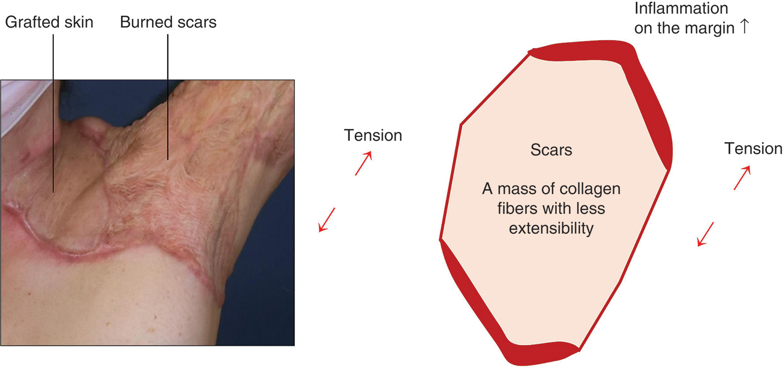 A diagram of grafted skin healing and a schematic of scar tension and inflammation patterns. The diagram consists of two parts illustrating scar formation and tissue mechanics. The left part features a photo of healed grafted skin with labeled areas indicating grafted skin and burned scars. The right part presents a schematic drawing depicting the relationship between tension, scars, inflammation, and tissue extensibility. The diagram demonstrates how scars with low extensibility experience increased tension at their margins, creating an inflammation zone that forms a peripheral area. Arrows indicate tension direction around the central scar region.