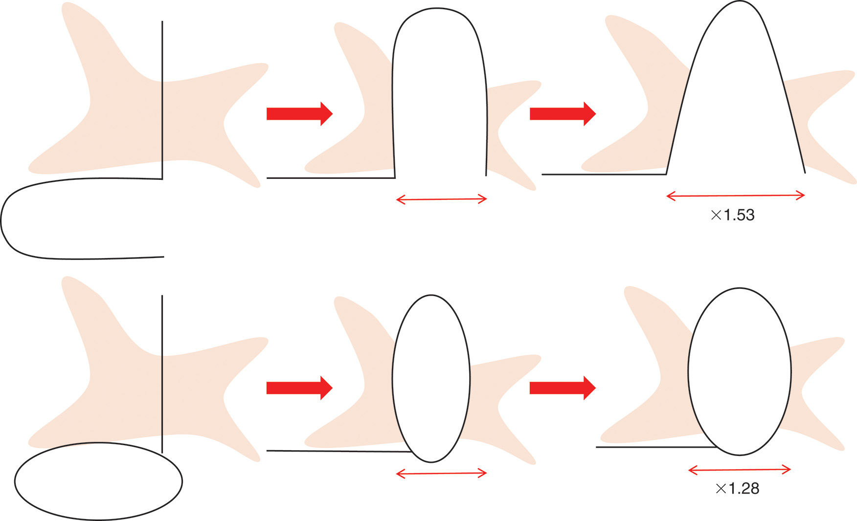 A diagram compares the extension capabilities of skin-pedicled flaps versus island flaps over time. The diagram compares the extension capabilities of skin-pedicled flaps versus island flaps through schematic illustrations. The top row demonstrates skin-pedicled flap progression, starting with an initial curved shape, then extending to a rounded form with arrows indicating direction of extension, and finally achieving greater height, indicated by plus 1.53. The bottom row demonstrates island flap progression, starting with an elliptical shape with surrounding tissue connections, then transitioning to a circular form with directional arrows, and ending with less extension indicated by plus 1.06. The diagram illustrates how skin-pedicled flaps achieve superior extensibility compared to island flaps following surgical procedures.