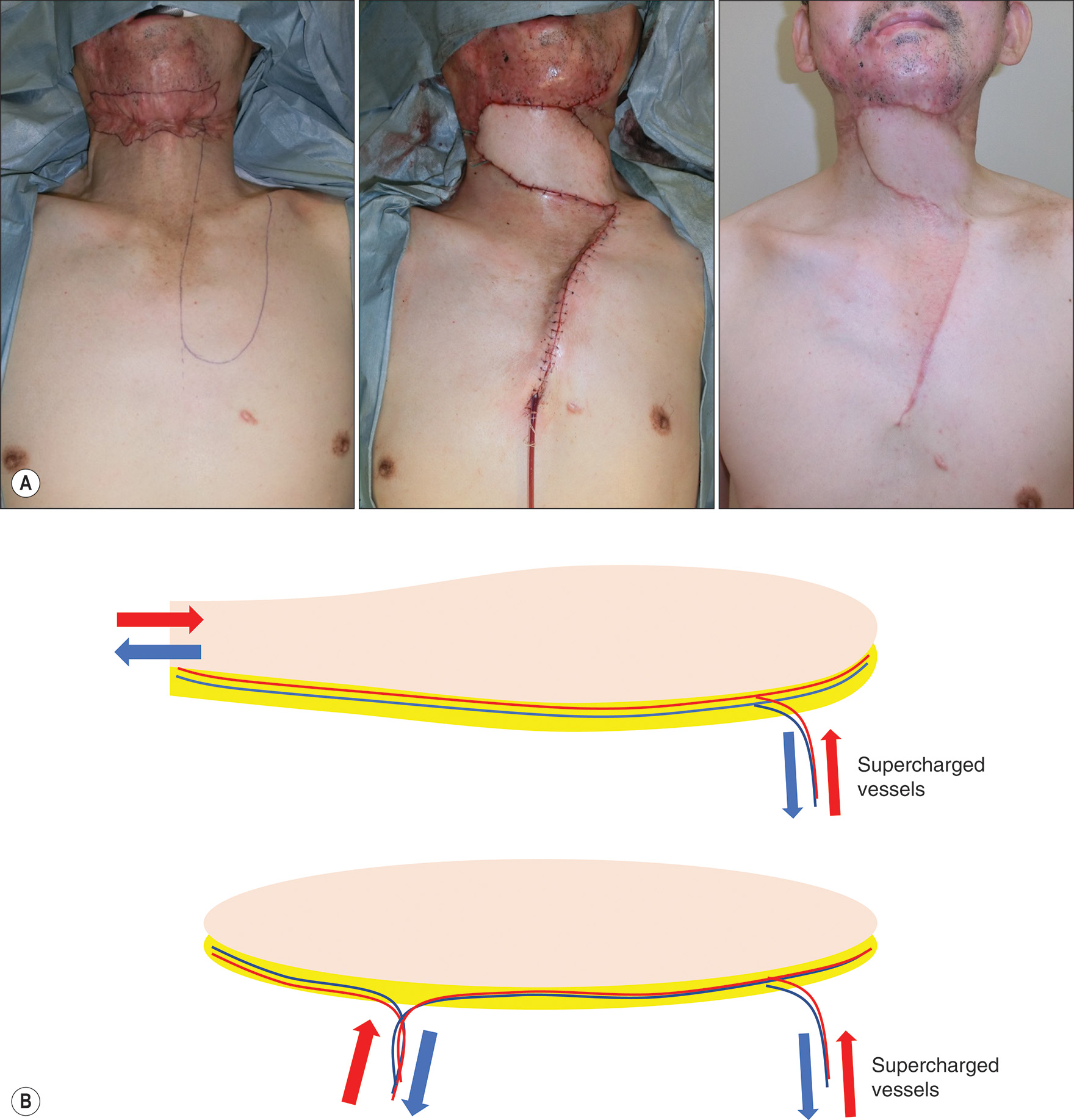 A photo series and diagrams of anterior neck contracture reconstruction using a large skin-pedicled flap with vascular enhancement techniques. The photo series and diagrams illustrate anterior neck contracture reconstruction using a large 19-centimeter by 6-centimeter skin-pedicled flap. Part A consists of three photos of a male patient in his sixties depicting preoperative contracture, immediate postoperative result, and 6 months postoperative outcome demonstrating successful contracture release and full flap survival. The flap pedicle was minimally elevated and manipulated carefully to promote survival. Part B contains two schematic diagrams illustrating the vascular enhancement technique. The diagrams show how attaching supercharged vessels on the periphery of flaps strengthens blood circulation and prevents peripheral congestion, with arrows indicating arterial and venous flow patterns through the flap tissue and its connections.