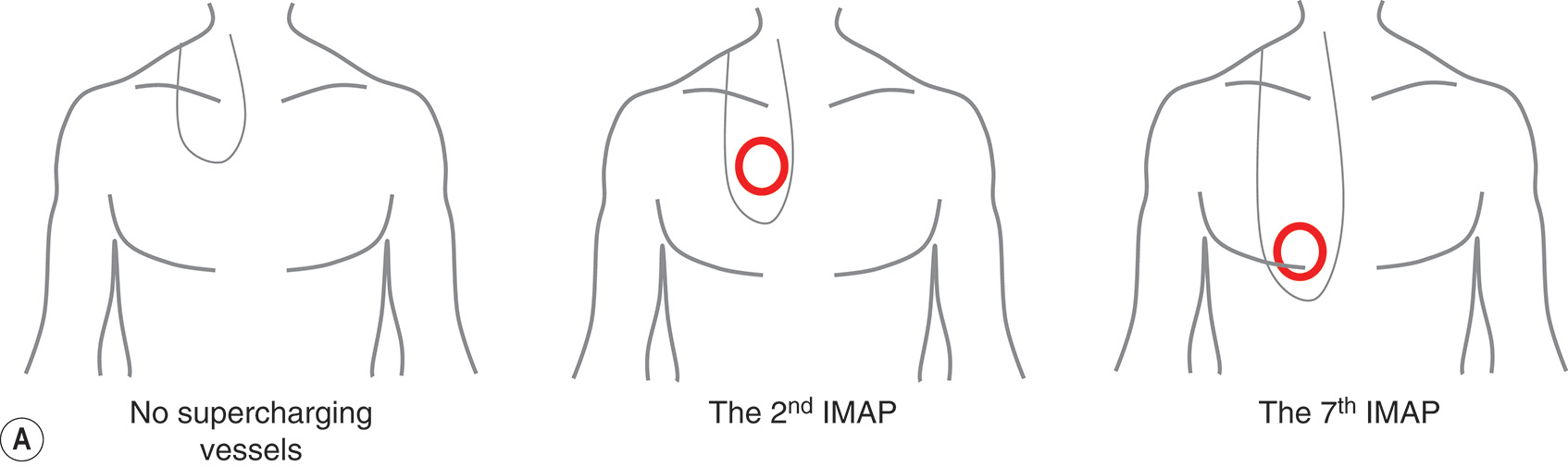 A diagram and photos of chest flap procedures for neck contracture reconstruction in two male patients with surgical outcomes. The diagram and photos of chest flap procedures for neck contracture reconstruction in two male patients with surgical outcomes. Part A contains three chest outlines. The first is titled Supercharged transverse with a circular marking on the right chest. The second is titled Trio flap detail with a circular marking on the center chest. The third is titled Trio flap detail with a circular marking on the left chest. Part B features three photos of a male patient with neck contracture preoperatively, the chest with surgical markings and exposed tissue during the procedure, and the patient after surgery. Part C features four sequential photos of the chest and neck area showing the healing progression over time. Part D features three photos of the chest with surgical markings preoperatively, exposed tissue with surgical instruments during the procedure, and a harvested flap specimen with a measuring ruler. Part E features four sequential photos of the chest and neck area showing the healing progression over time.