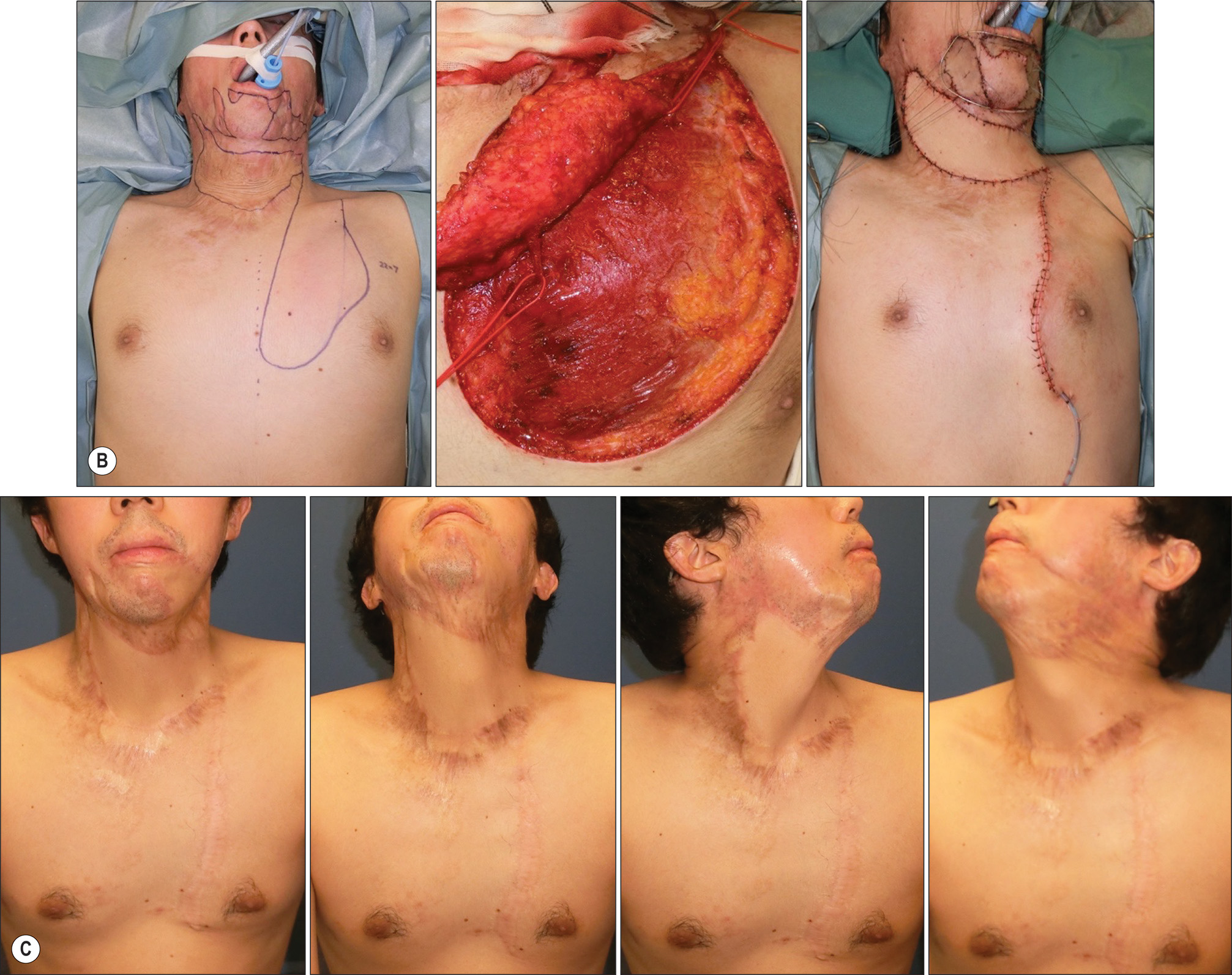 A diagram and photos of chest flap procedures for neck contracture reconstruction in two male patients with surgical outcomes. The diagram and photos of chest flap procedures for neck contracture reconstruction in two male patients with surgical outcomes. Part A contains three chest outlines. The first is titled Supercharged transverse with a circular marking on the right chest. The second is titled Trio flap detail with a circular marking on the center chest. The third is titled Trio flap detail with a circular marking on the left chest. Part B features three photos of a male patient with neck contracture preoperatively, the chest with surgical markings and exposed tissue during the procedure, and the patient after surgery. Part C features four sequential photos of the chest and neck area showing the healing progression over time. Part D features three photos of the chest with surgical markings preoperatively, exposed tissue with surgical instruments during the procedure, and a harvested flap specimen with a measuring ruler. Part E features four sequential photos of the chest and neck area showing the healing progression over time.