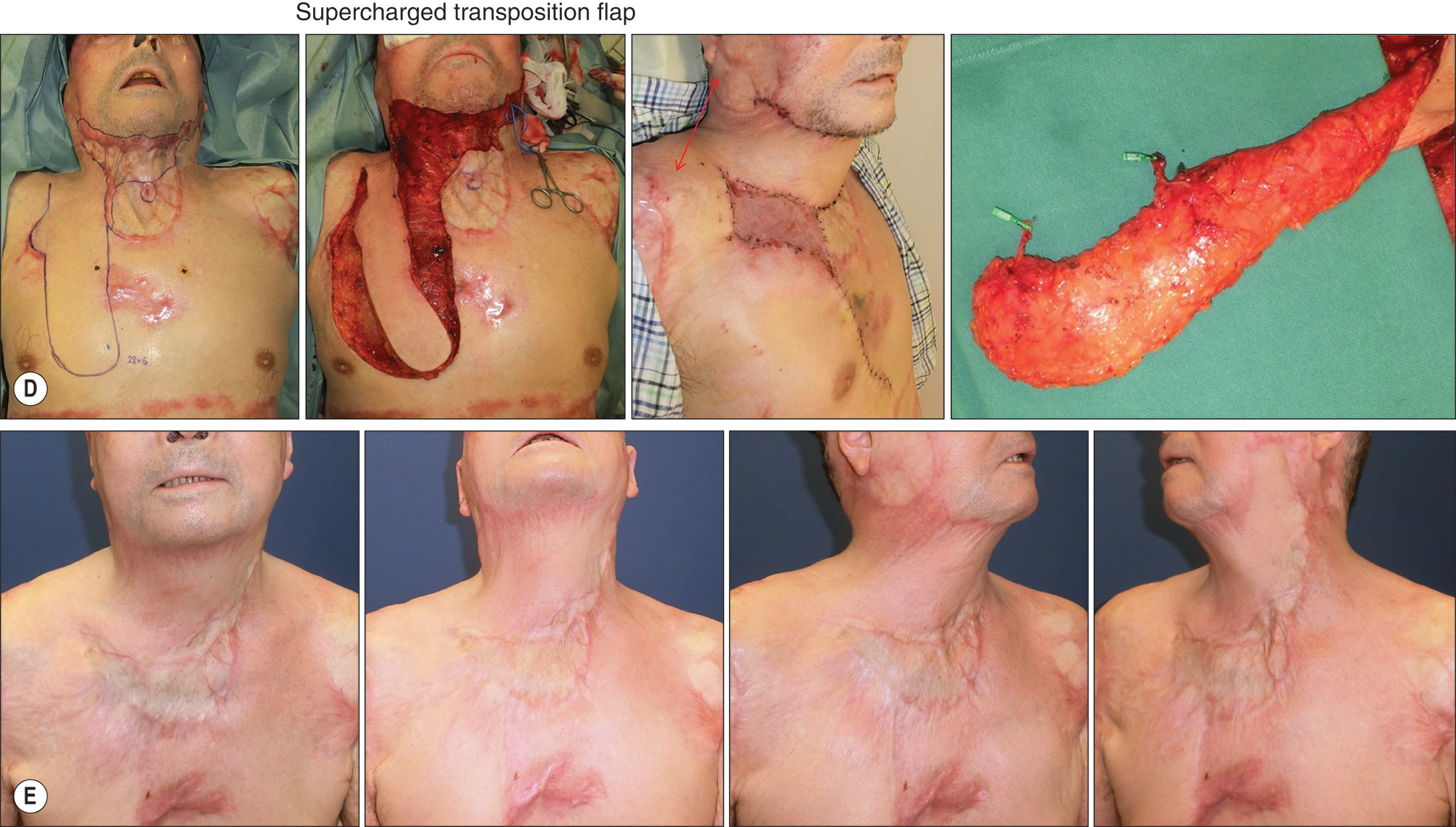 A diagram and photos of chest flap procedures for neck contracture reconstruction in two male patients with surgical outcomes. The diagram and photos of chest flap procedures for neck contracture reconstruction in two male patients with surgical outcomes. Part A contains three chest outlines. The first is titled Supercharged transverse with a circular marking on the right chest. The second is titled Trio flap detail with a circular marking on the center chest. The third is titled Trio flap detail with a circular marking on the left chest. Part B features three photos of a male patient with neck contracture preoperatively, the chest with surgical markings and exposed tissue during the procedure, and the patient after surgery. Part C features four sequential photos of the chest and neck area showing the healing progression over time. Part D features three photos of the chest with surgical markings preoperatively, exposed tissue with surgical instruments during the procedure, and a harvested flap specimen with a measuring ruler. Part E features four sequential photos of the chest and neck area showing the healing progression over time.