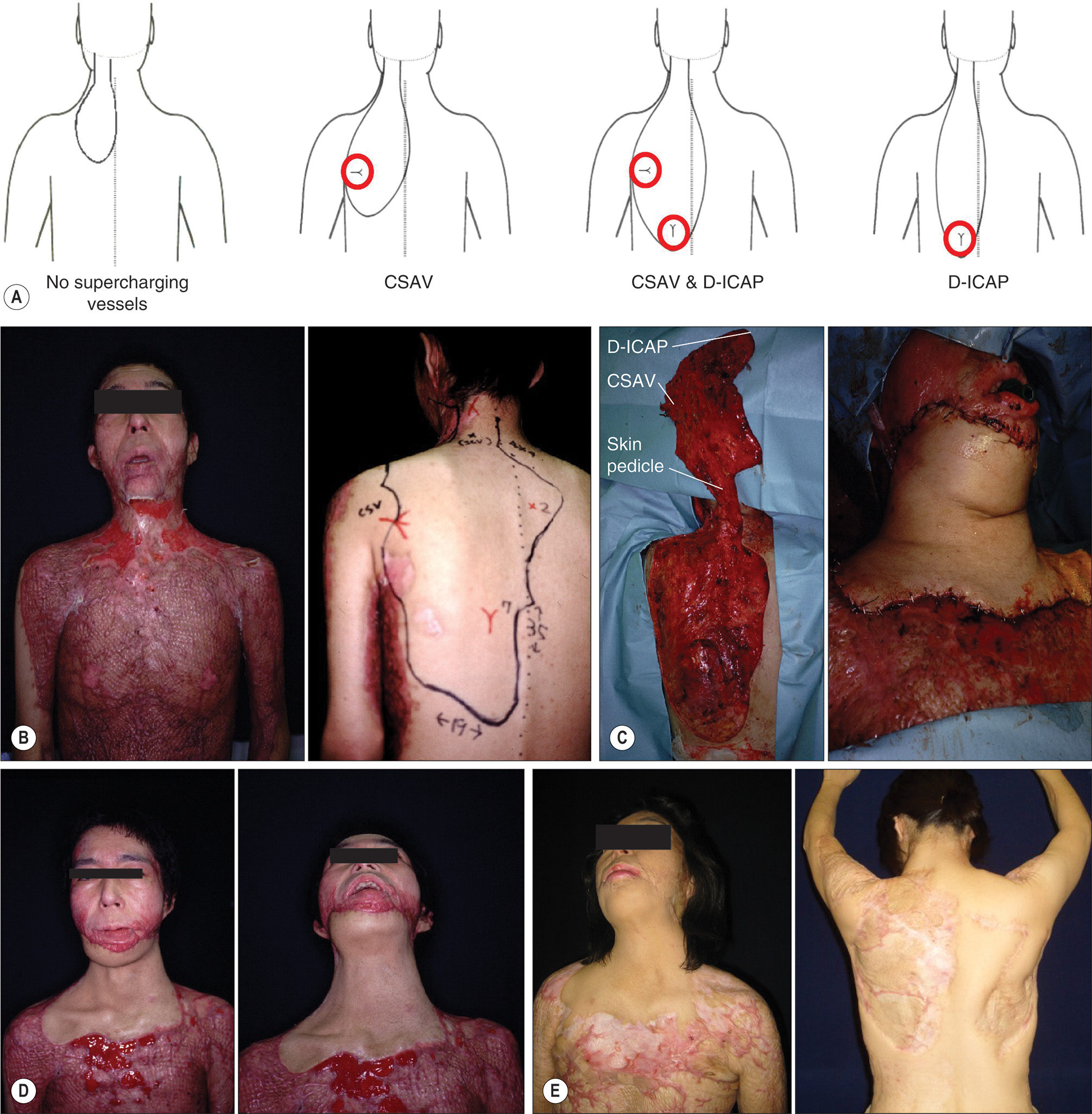 A diagram and photos of dorsal flap procedures for neck contracture reconstruction in a female patient with surgical outcomes. The diagram and photos of dorsal flap procedures for neck contracture reconstruction in a female patient with surgical outcomes. Part A contains four body outlines from behind. The first outline has a circular marking labeled P on the right upper back. The second outline has a circular marking labeled P on the center upper back. The third outline has a circular marking labeled P on the left upper back. The fourth outline has a circular marking labeled G at the center back. Part B features four photos of the patient with neck contracture preoperatively, the back with surgical markings, exposed tissue during the procedure, and the neck area after surgery. Part C features four photos with the patient preoperatively, the back from behind, exposed harvested tissue, and the neck area postoperatively. Part D features four photos of the chest and neck area from different angles showing the healing progression. Part E features four photos of the chest and neck area from different angles showing the healing progression.