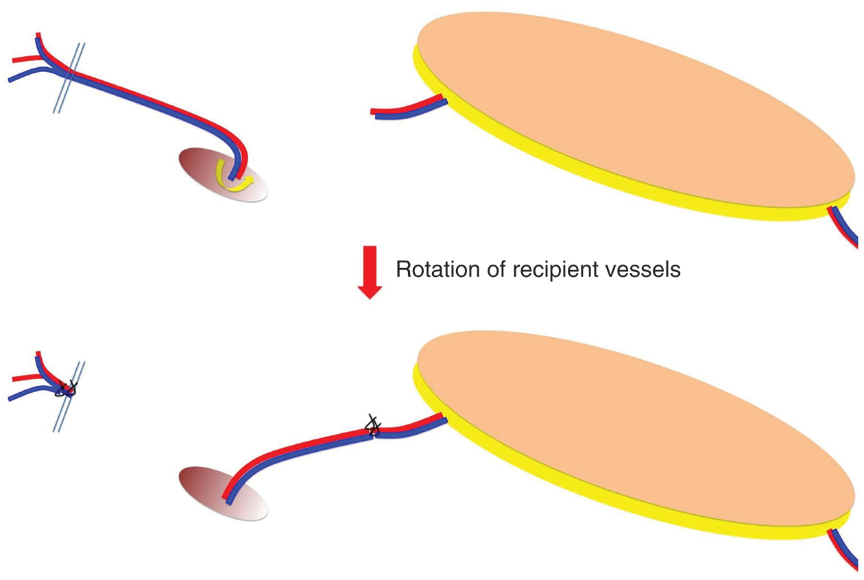 A medical diagram of flap rotation and vascular anastomosis when pedicle length is insufficient to reach recipient vessels. The medical diagram demonstrates a surgical technique for managing insufficient pedicle length in flap procedures. The left side contains explanatory text stating that if the pedicle length is short and does not reach the recipient's vessels, it can be rotated and anastomosed. The right side shows two anatomical illustrations of flap rotation with vascular pedicles. The upper illustration depicts a flap with its vascular pedicle and labeled anatomical superior vascular vessels. The lower illustration shows the same flap after rotation, demonstrating how the pedicle can be repositioned to enable vascular anastomosis when the original pedicle length is inadequate.