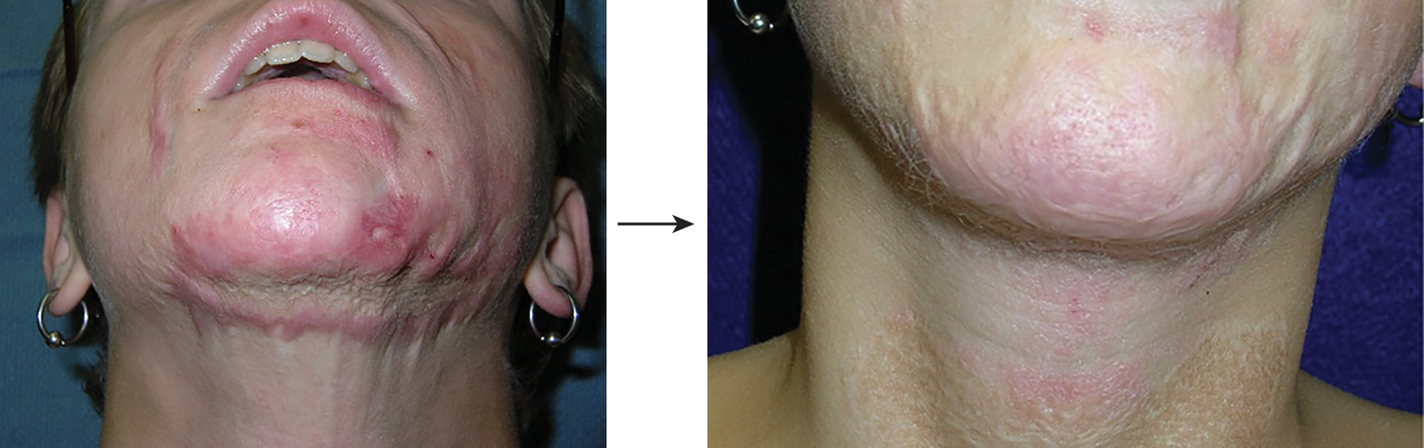 A photo of hypertrophic chin and neck scar before and after three nonablative erbium glass laser treatments with follow-up. The photo demonstrates hypertrophic scar treatment on the chin and neck region before and after nonablative erbium glass laser therapy. The left photo shows the pretreatment condition with a prominent hypertrophic scar extending from the chin to the neck area. The right photo depicts the result after three nonablative erbium glass laser treatments at one month and seven months postepithelialization. The treated scar demonstrates improved texture, reduced thickness, and better integration with surrounding tissue. An arrow between the two photos indicates the progression from pretreatment to posttreatment status.
