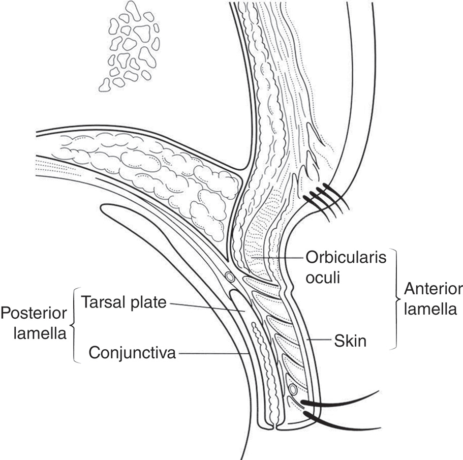 A diagram of the eyelid anatomy in cross-section with labeled structures. The diagram shows the eyelid anatomy in cross-section with labeled anatomical structures. The diagram identifies the orbicularis oculi muscle, tarsal plate, conjunctiva, posterior lamella, anterior lamella, and skin. The cross-section demonstrates the layered arrangement of tissues from the external surface to the internal structures of the eyelid.