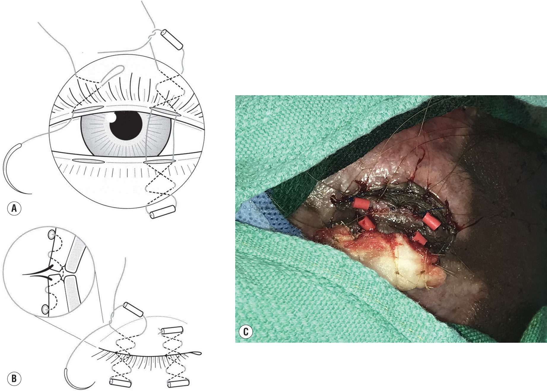 Two diagrams of intermarginal tarsorrhaphy surgical technique and a photo of a person with the procedure and eyelid releases with a bolster. The two diagrams and photo demonstrate the intermarginal tarsorrhaphy surgical technique. Panels A and B show diagrams of the intermarginal tarsorrhaphy technique with suture placement through the eyelid margins. Panel C shows a photo of a person with intermarginal tarsorrhaphy and grafted upper and lower eyelid releases, with a bolster in place securing the surgical repair.