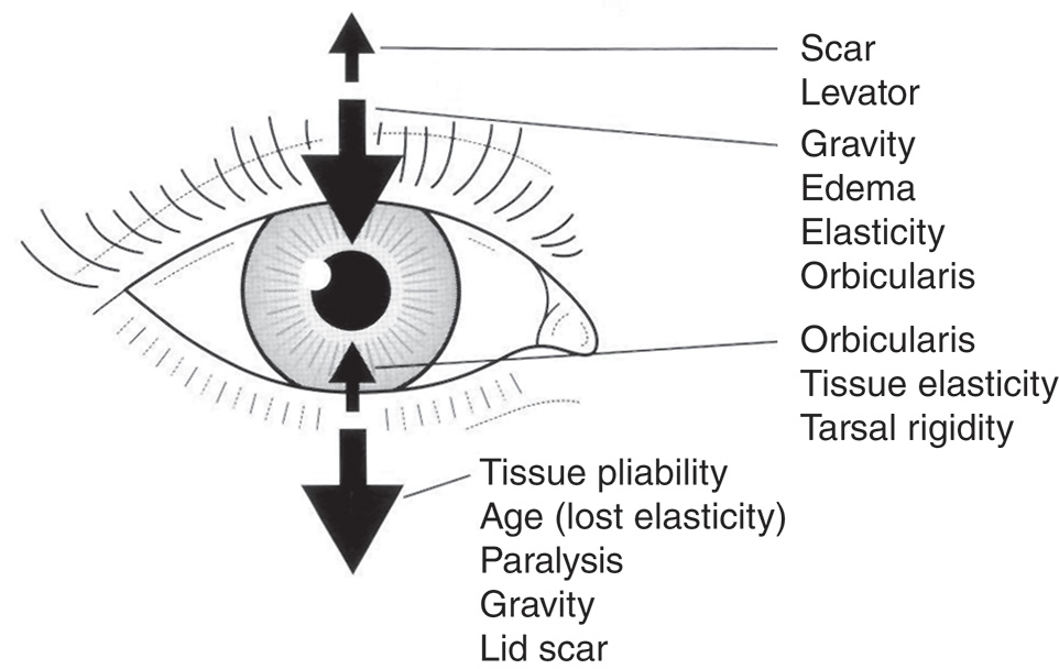 A diagram of eyelid forces with arrows and labeled anatomical factors affecting eyelid position. The diagram demonstrates eyelid forces acting on the eye, with upward and downward arrows indicating directional forces. The diagram labels multiple factors that influence eyelid positioning and function. The upward forces include the scar levator. The downward forces and resistance factors include gravity, edema, elasticity, orbicularis, orbicularis tissue elasticity, tarsal rigidity, tissue pliability, age with lost elasticity, paralysis, gravity, and lid scar. The diagram centers on an eye with eyelashes and anatomical structures to show how these forces interact.