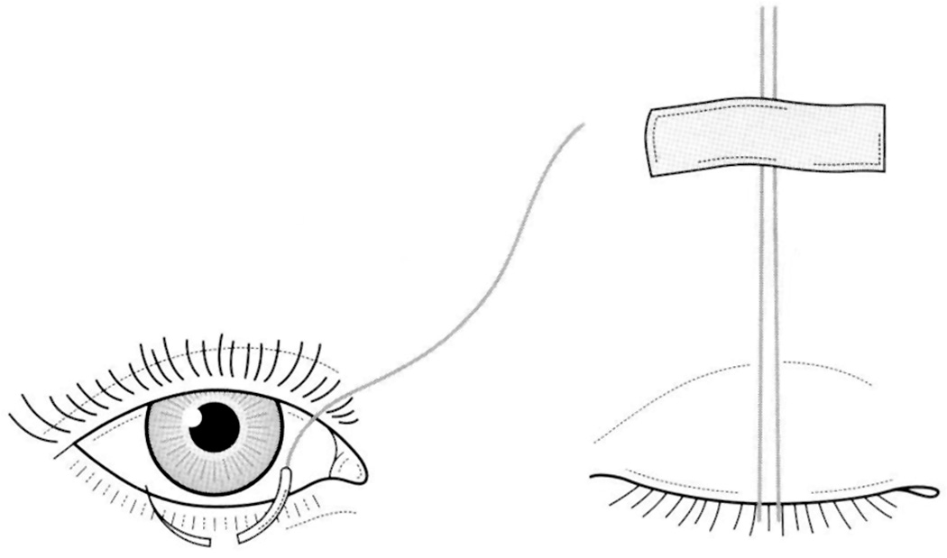 A diagram of the Frost stitch suture technique for temporary eyelid closure. The diagram demonstrates the Frost stitch suture technique for temporary eyelid closure. The left panel shows a frontal view of an eye with a suture passing through the lower eyelid. The right panel shows a lateral view with the suture extending upward and secured to the forehead or upper face with tape, holding the lower eyelid in an elevated position.