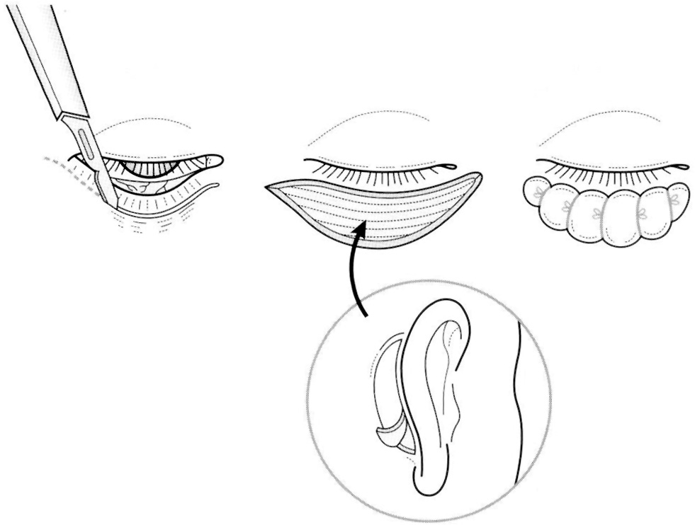 A diagram of lower eyelid ectropion release and full thickness skin graft surgical technique. The diagram demonstrates the surgical technique for lower eyelid ectropion release and full-thickness skin graft. The left panel shows a cross-sectional view with a surgical instrument releasing the contracted eyelid tissue. The upper right panel shows the harvested full-thickness skin graft with sutures along its edge. The middle right panel shows the graft being positioned and secured to the released eyelid. The lower right panel shows a detailed view of the donor site, typically from the preauricular or postauricular area, where the full-thickness skin graft is harvested.