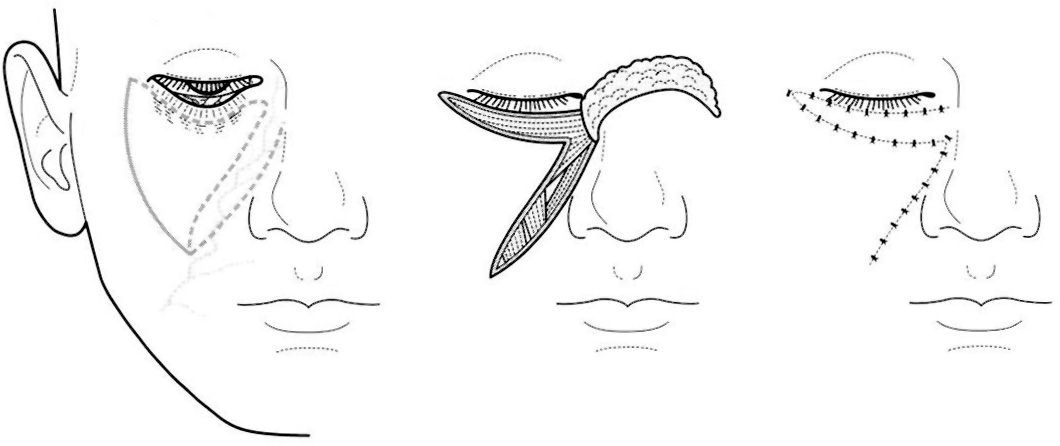 A diagram of lower eyelid ectropion release and nasolabial flap surgical technique. The diagram demonstrates the surgical technique for lower eyelid ectropion release and nasolabial flap reconstruction. The left panel shows a lateral view of the face with the nasolabial flap outlined in the cheek area. The center upper panel shows the frontal view of the eye with the ectropion. The center lower panel shows the nasolabial flap being elevated and rotated. The right upper panel shows the flap being transferred to the lower eyelid defect. The right lower panel shows the final suture closure with the flap secured to the released lower eyelid margin.