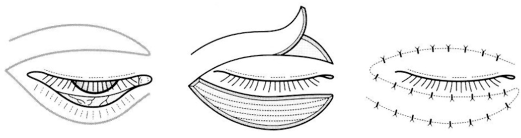 A diagram of lower eyelid ectropion release and upper eyelid myocutaneous flap surgical technique. The diagram demonstrates the surgical technique for lower eyelid ectropion release and upper eyelid myocutaneous flap reconstruction. The left panel shows the upper and lower eyelids with the outlined myocutaneous flap marked on the upper eyelid. The center panel shows the flap being elevated and rotated downward from the upper eyelid toward the lower eyelid defect after ectropion release. The right panel shows the final suture closure with the myocutaneous flap secured to the released lower eyelid margin with multiple interrupted sutures along the reconstructed eyelid edge.