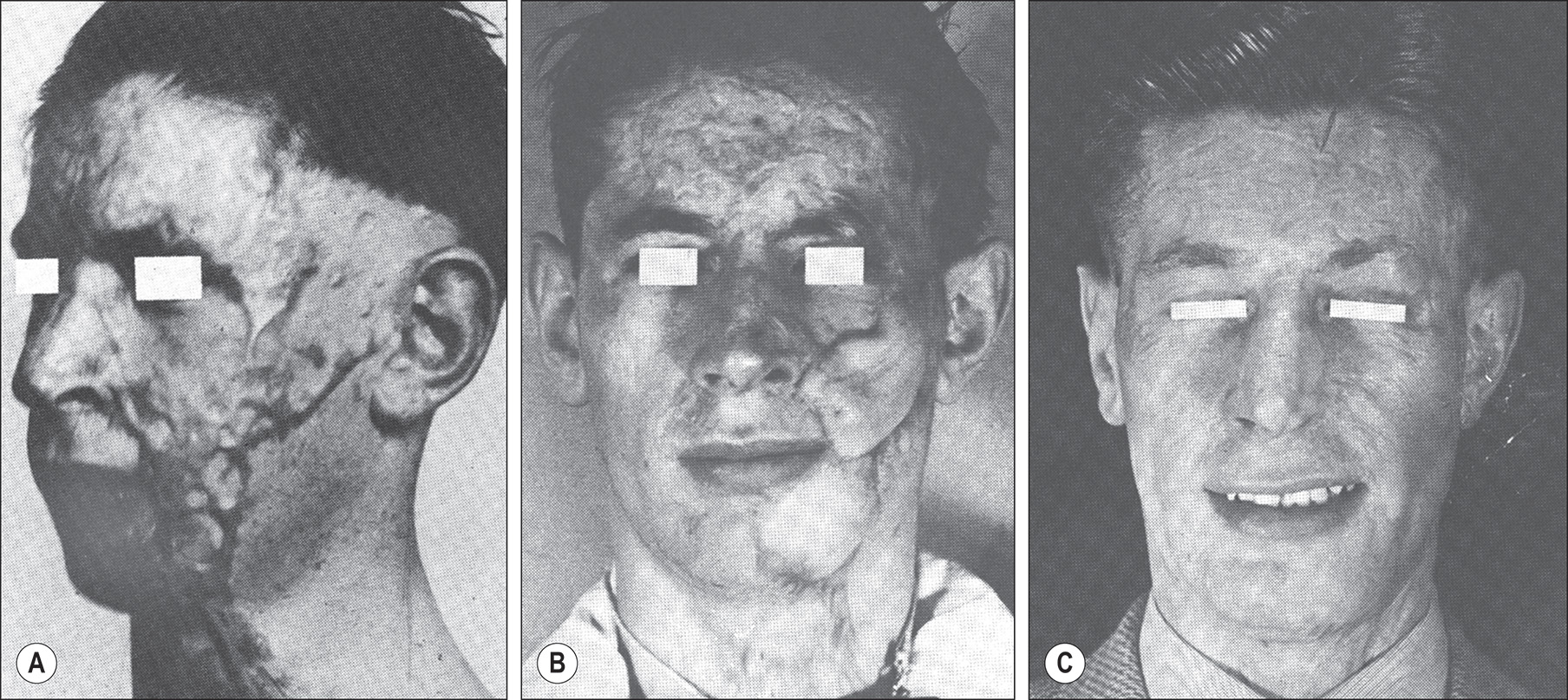 Three grayscale photos of a World War One British Army soldier showing facial reconstruction progression from nineteen eighteen. The three grayscale photos show a World War One British Army soldier displaying facial reconstruction progression from nineteen eighteen. The first photo shows the soldier with facial burn scars. The second and third photos show the results after Sir Harold Gillies excised the scars and replaced them with a tubed pedicle flap of abdominal skin. The flap resulted in a beardless left face with different-textured skin. There is a slight lateral and upward contracture of the left oral commissure.