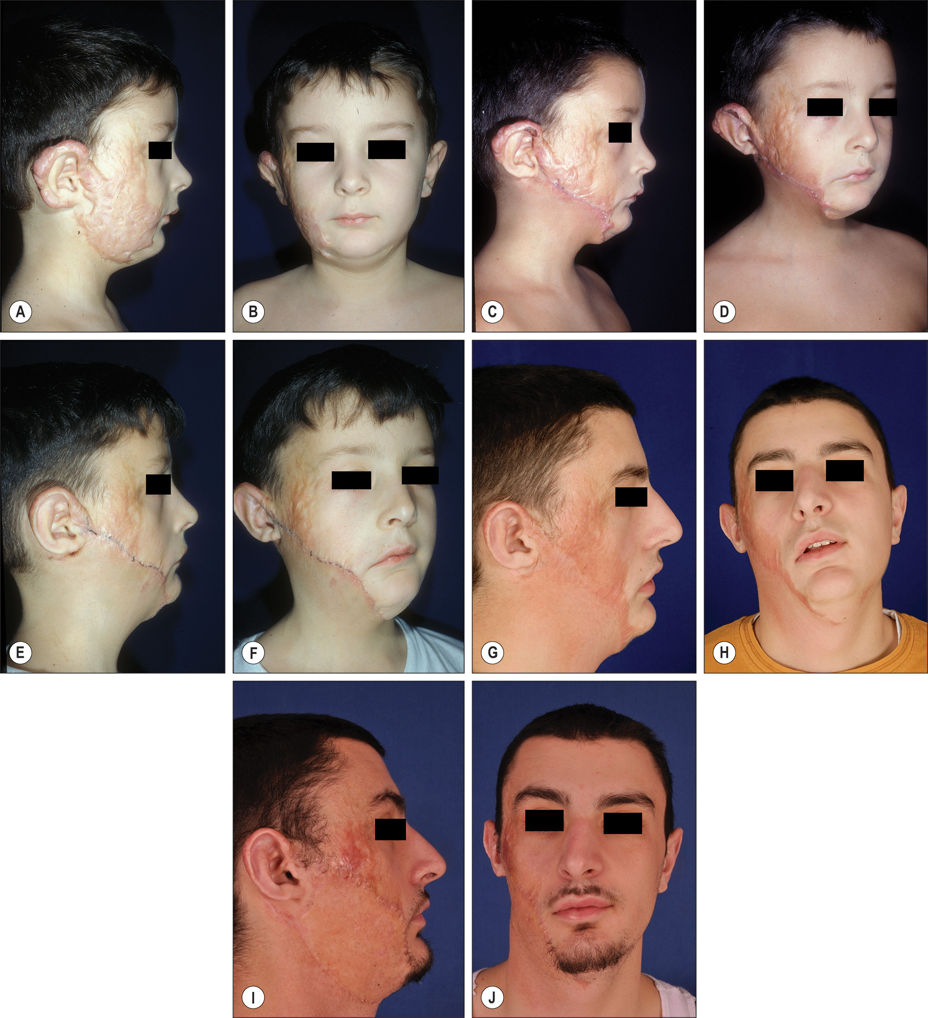 A photo series of a young male with extensive hypertrophic burn scars to the right face showing facial deformity results from scar excision and advancement flap. The photo series of a young male patient with facial burn scar treatment progression. Part A features two photos of the patient from the side, showing the right profile and from the front, showing extensive scarring on the right side of the face. Part B features two photos of the patient from the side, showing the right profile, and from the front after initial treatment, showing changes to facial structure. Part C features two photos of the patient from the side, showing the right profile, and from the front, showing progression with altered facial features. Part D features two photos of the patient from the side, showing the right profile, and from the front, showing further progression with changes to the mouth and eye area. Part E features two photos of the patient from the side, showing the right profile, and from the front, showing continued progression with visible changes to facial symmetry.