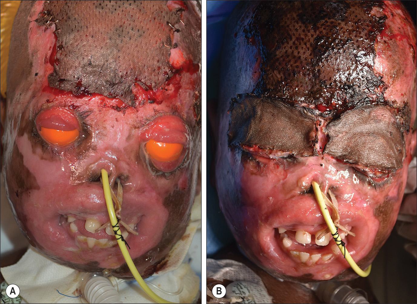 Two photos of a seven-year-old child with third and fourth-degree facial burns showing open wounds and severe contractures before and after upper eyelid release and grafts. The two photos show a seven-year-old child with third and fourth-degree facial burns. Photo A shows open wounds of the forehead and scalp that were present months after the initial injury was treated in his home country. Open wounds led to full-thickness loss of the lower lip and devastating contractures and contraction of multiple areas, most dramatically the upper and lower eyelids, lips, and cheeks. The photo shows bilateral upper eyelid ectropion. Photo B shows results after the upper eyelids were released and grafted with split-thickness skin grafts. Cosmetic issues were addressed later in the recovery period.