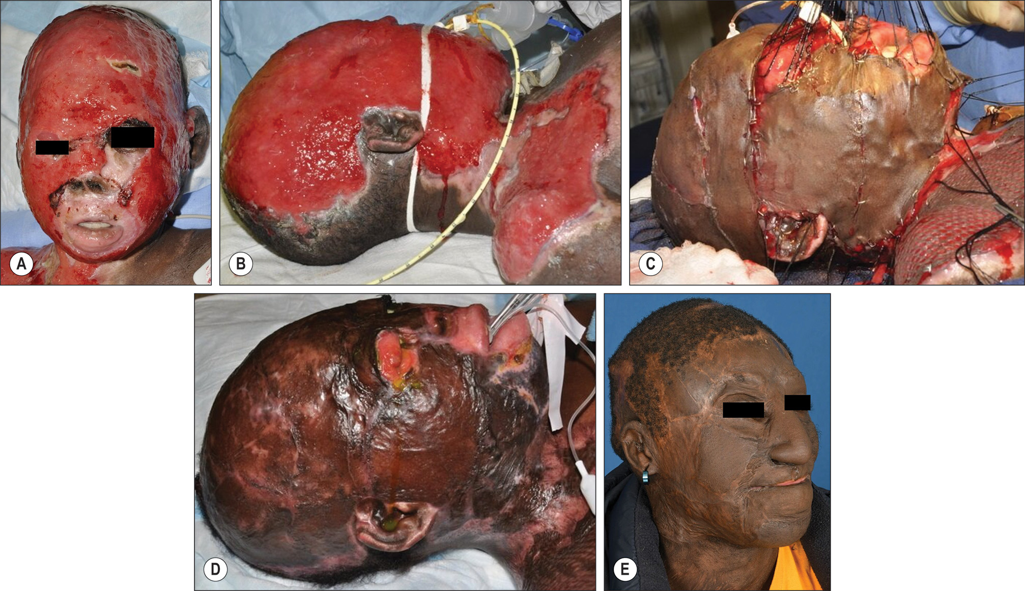 Six photos labeled A through F of panfacial full thickness burns requiring primary excision and coverage with split thickness skin grafts shown at different stages of treatment and recovery. The photo series of a patient with panfacial full-thickness burns and reconstruction. Part A features two photos of the face with exposed tissue and surgical markings, and a side view with exposed tissue. Part B features two photos of the face with surgical mesh or material covering the tissue and a side view with similar material. Part C features two photos of the face with grafted tissue and a side view with grafted tissue. Part D features two photos of the face with healing grafted tissue and a side view with healing grafted tissue. Part E features two photos of the face after reconstruction and a side view after reconstruction.